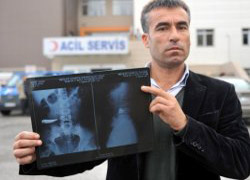 9 yıl karnında bıçakla yaşadı