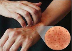 Hayat şartları alerji yapıyor
