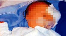 Doğum kaşığı bebeğin sol gözünü çıkardı