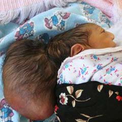İki başlı bebek öldü