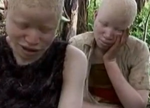 Afrikanın Beyaz Ayıbı: Albino Cinayetleri