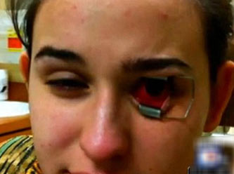 Lensteki Kurt Gözünü Yedi!