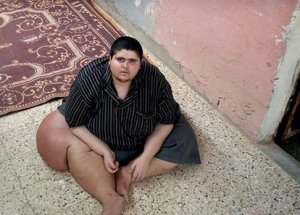 Filistinli Obez Genç Yardım Bekliyor