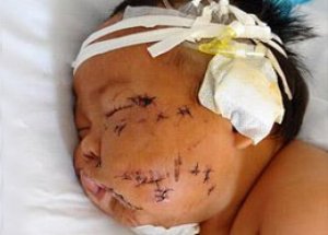 Bebeğinin Yüzünü 90 Yerinden Kesti