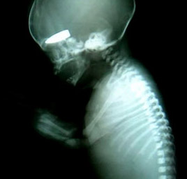 Doğmamış Çocuklar Hedef