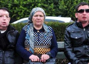 Türkiye'nin 7'nci Yüz Nakli Gerçekleşecek