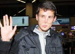 Türkiye'nin 7'inci Yüz Nakli Yapıldı