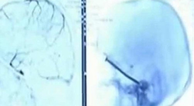 Kafasına saplanan çiviyi fark etmedi