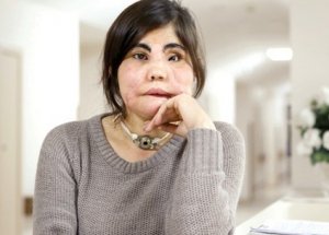 Türkiye'nin İlk Yüz Nakli Olan Kadını