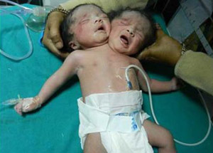 Çift Başlı Bebek Dünyayı Şoke Etti!