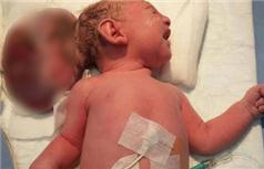 İki Kafalı Doğan Bebek Sağlığına Kavuştu