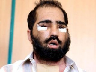 Nakledilen Yüzün Geri Alınmasıyla İlgili Açıklama