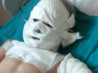 Patlamayan İftar Topu Çocuğun Elinde Patladı