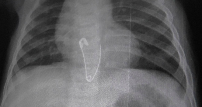 8 Aylık Bebek Bakın Ne Yuttu!