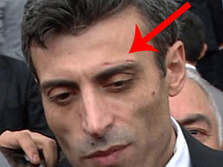 Başkonsolosa Alnındaki Çizik Soruldu