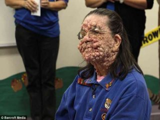 Bu Hastalık Yüzünden Herkesden Uzakta Yaşıyor