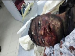 HDP'liler Hüda Par'lı Gencin Kafasını Taşla Ezdi