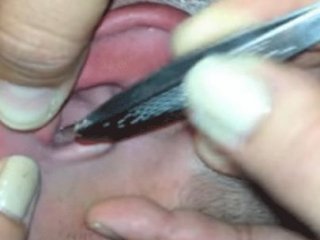 Kulağından Öyle Bir Şey Çıktı Ki..