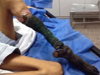 Yılan Isırığı Bu Hale Getirdi