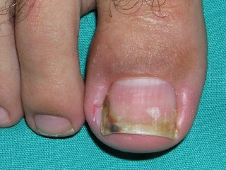 Tırnak Batması Bir Saatte Tedavi Ediliyor