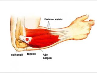 'Tenisçi Dirseği Hastalığı' na Dikkat!