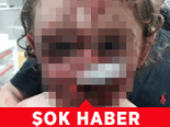 18 Aylık Bebeği Bu Hale Getirdi