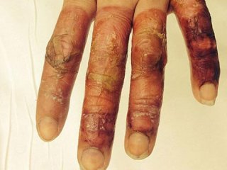 İçki Yüzünden Ölüyordu