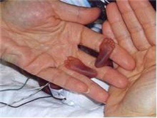 284 gram doğmuştu, şimdi ne halde?