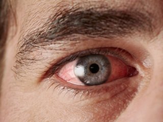 Kuru Göz Hastalığının Nedenleri ve Tedavisi