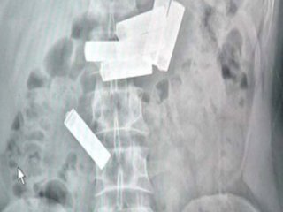 Cezaevindeki Mahkumun Midesindekiler Şok Etti