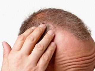 Her Saç Dökülmesi Mezoterapi Tedavisine Uygun Olmayabilir