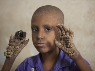 Ne yemek yiyebiliyor ne de yürüyebiliyor!