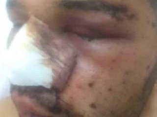 Uzman Onbaşı:Bir gözü kaybettiysek diğeri bize yeter