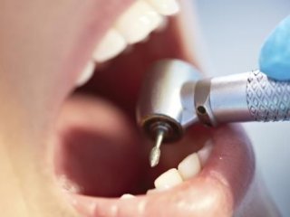 Diş dolgusu tarih oluyor!