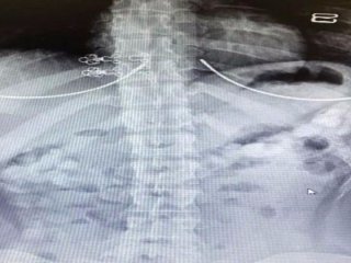 5 bin dolara iç organlarına uyuşturucu doldurmuş