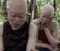 Afrika'nın "Beyaz" Ayıbı: Albino Cinayetleri